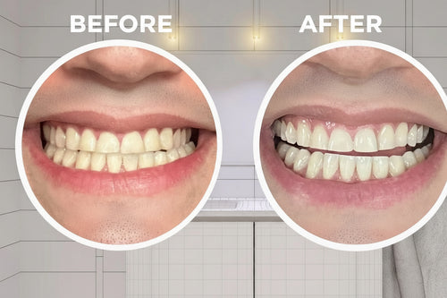 D White Strips - Make Your Smile White Again